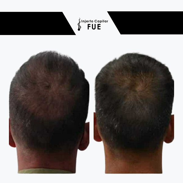 injerto capilar antes y despues mujer