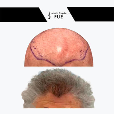 injerto capilar de barba