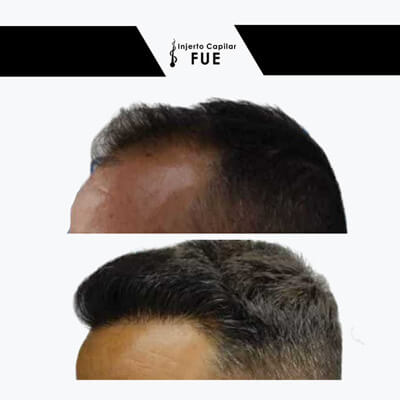 injerto capilar en barba