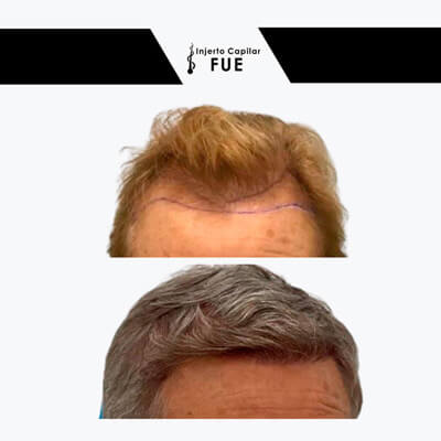 injerto capilar con barba