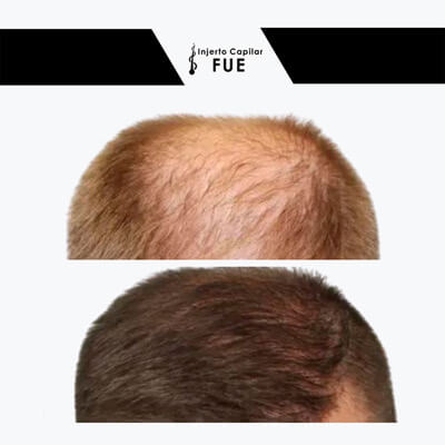 injerto capilar con pelo de barba